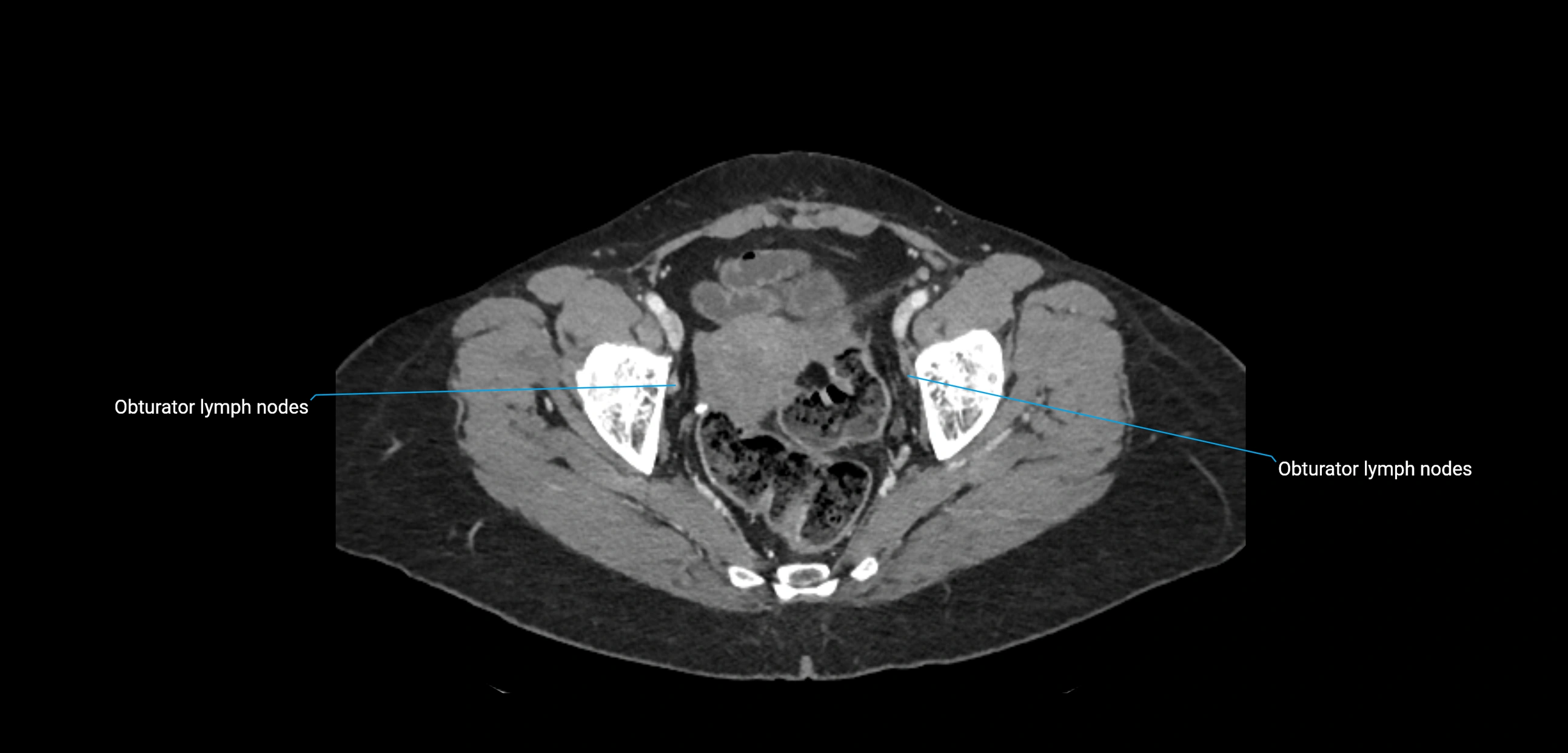 CT ct abdominal lymph nodes  axial cross sectional anatomy  enchanced radiology image -img-00002-00369.webp